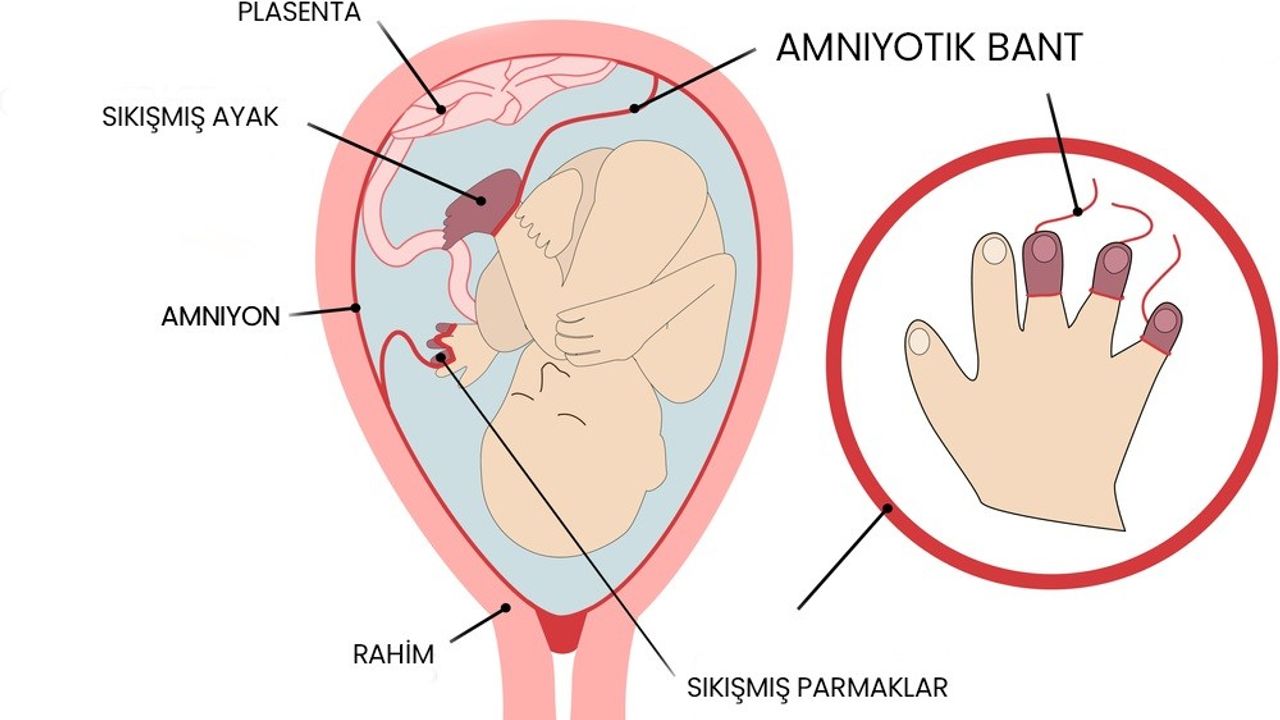 Amniyotik bant sendromu olan bebekler anne karnında ameliyat ile tedavi edilebiliyor