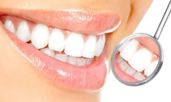 Diş beyazlatmada doğru bilinen yanlışlar!