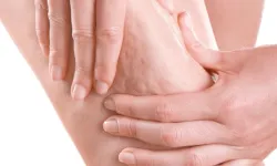 Selülit uyarısı: Portakal kabuğu görüntüsü basit sorun değil!