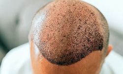 Saç Ekimi Antalya – Haarex Clinic