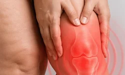 Diz biyomekaniğini bozan süreç: Lipödem