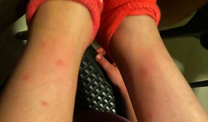 Alanya'da 'Sivrisinek istilası' isyanı: Çocukların vücutları yara içerisinde  