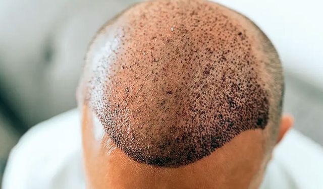 Saç Ekimi Antalya – Haarex Clinic