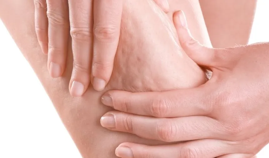 Selülit uyarısı: Portakal kabuğu görüntüsü basit sorun değil!