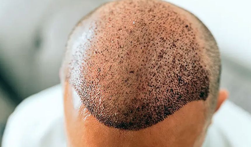 Saç Ekimi Antalya – Haarex Clinic